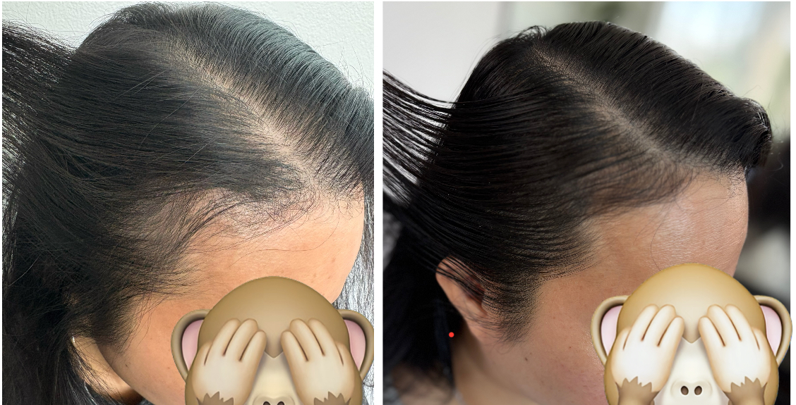 SMP Before and After Treatment
